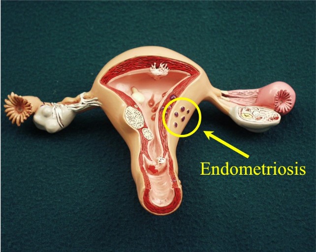 Consult the best endometriosis doctor at ISHA IVF for expert Dienogest treatment and personalized care to manage your endometriosis symptoms effectively.