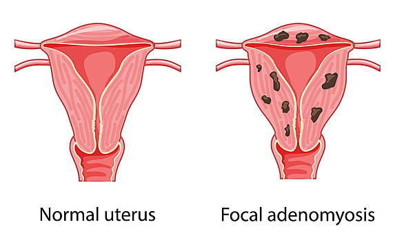 Focal Adenomyosis and Infertility | Causes, Symptoms & Treatment