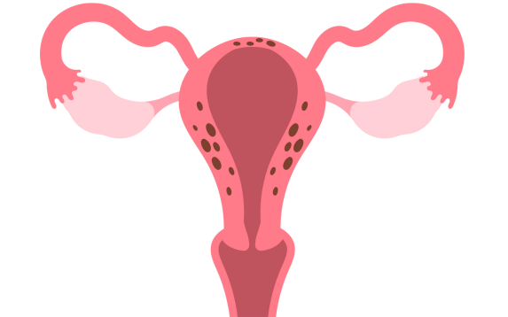 Adenomyosis