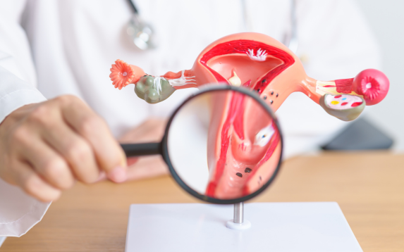 Endometriosis