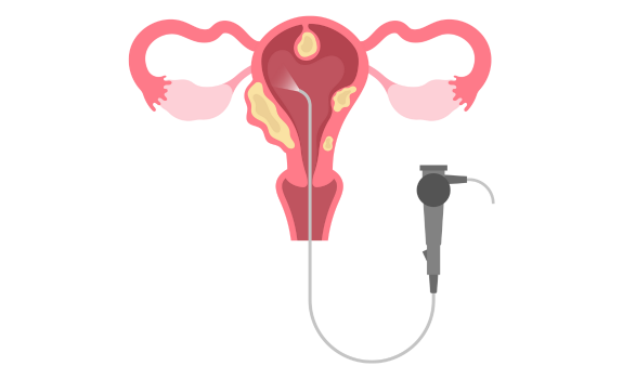 Laparoscopy & Hysteroscopy