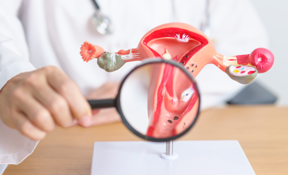 PCOS-Endometriosis-Fibroids