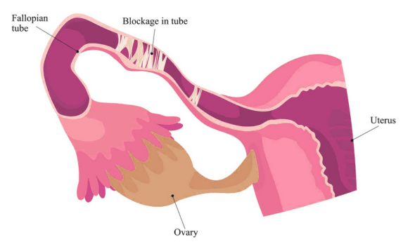 Blocked Fallopian Tube