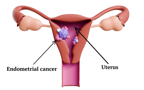 Endometrial cancers