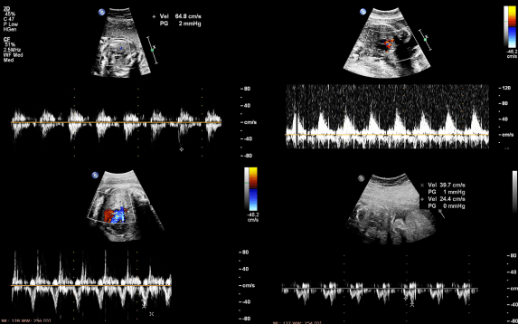 Fetal echocardiography in Palanpur