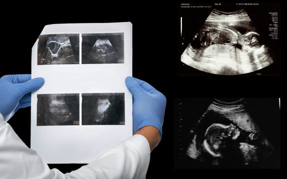 Genetic sonogram in Palanpur