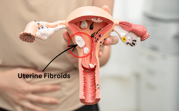 Uterine Fibroids