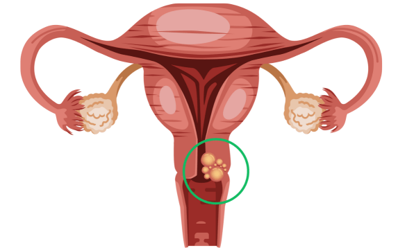 Vulvar Cancer Treatment in Palanpur