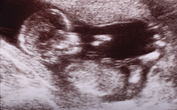 Nuchal Translucency (NT) Scan in Palanpur