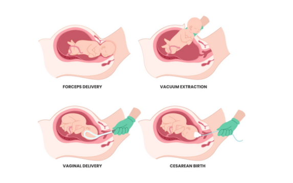 Assisted Delivery (Forceps/Vacuum)