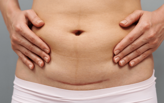 Best Scar Endometriosis Treatment in Palanpur