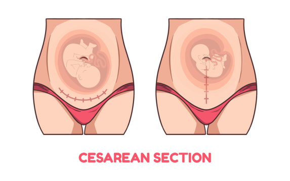 Cesarean Section(C-Section)