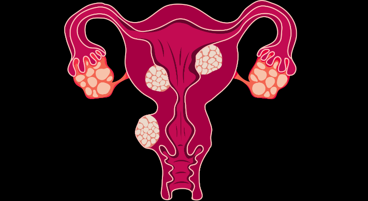 Endometriosis at Isha IVF Centre