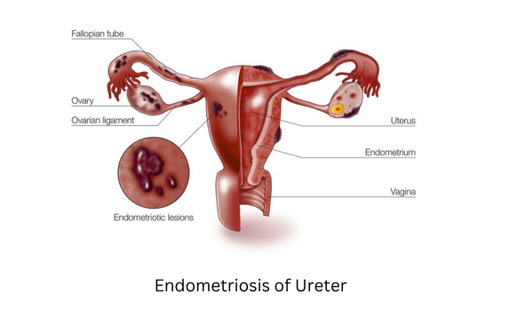 Endometriosis of Ureter Treatment in Palanpur