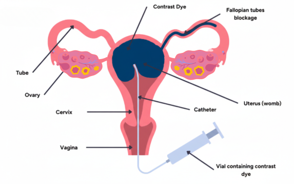 Fallopian Tube Check_