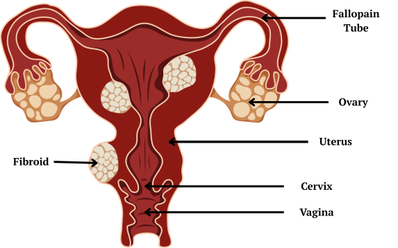 Fibroid Removal