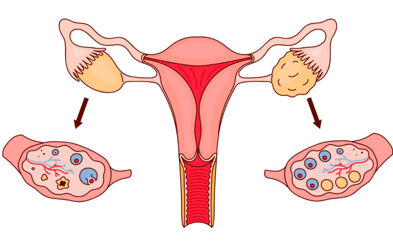 How PCOS is Diagnosed