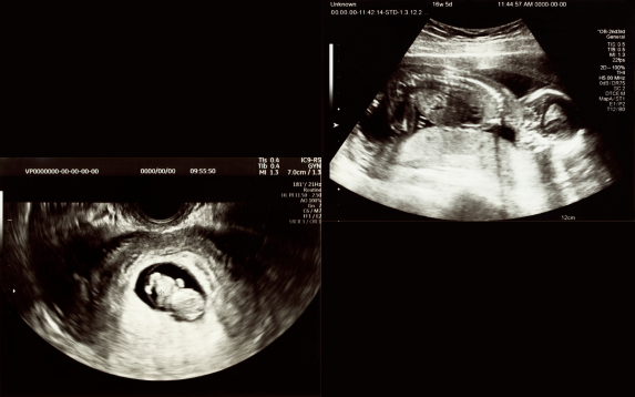OB/GYN Ultrasound in Pregnancy