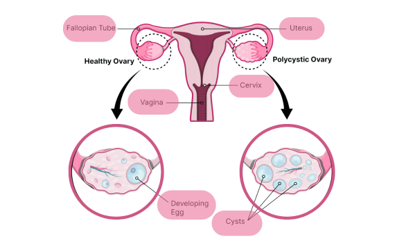 PCOS and Fertility