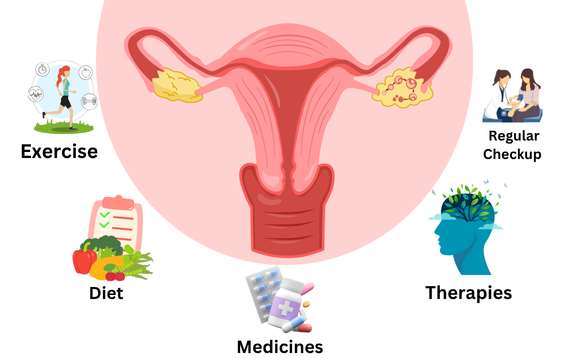 Treatment Options for PCOS