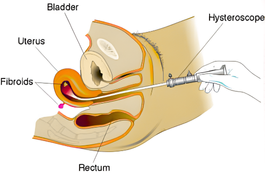 Operative Hysteroscopy