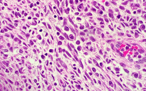 Chronic Endometritis Treatment in Palanpur