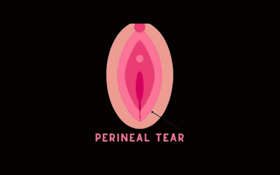 perineal repair