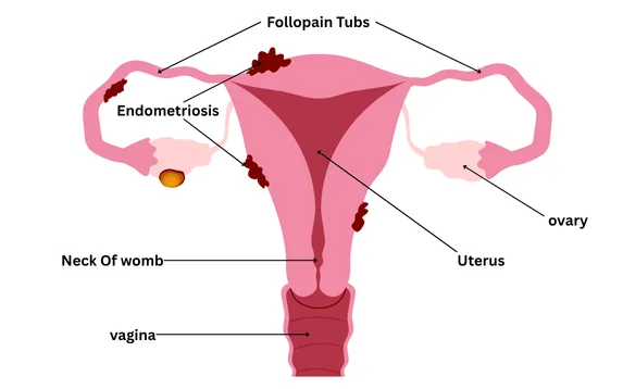 Best Endometriosis Mapping in Palanpur
