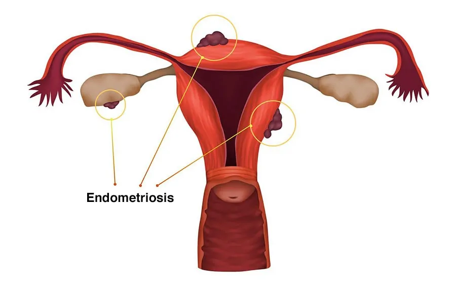Endometriosis Treatment in Palanpur