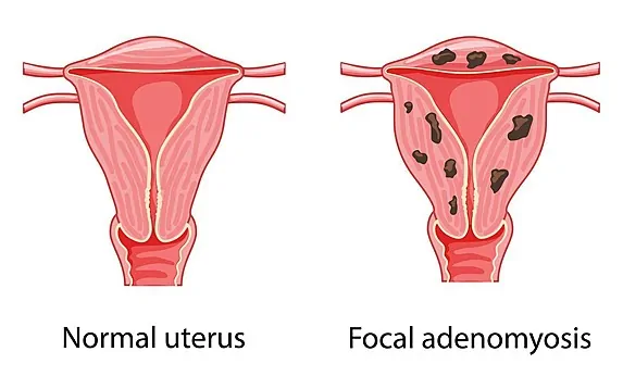 Globular Adenomyosis Treatment in Palanpur